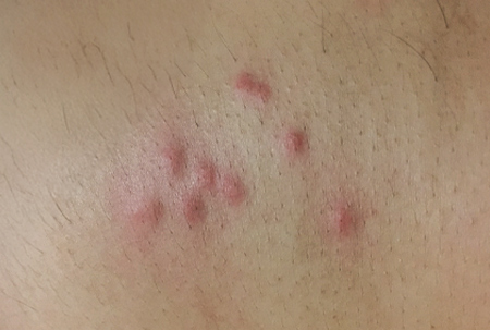 Punture cimici letto